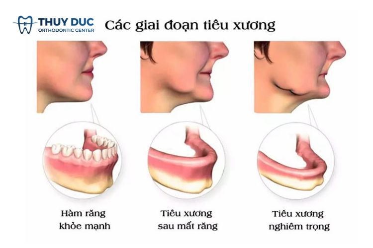 Tại sao mất răng số 6 phải trồng lại ngay? 1