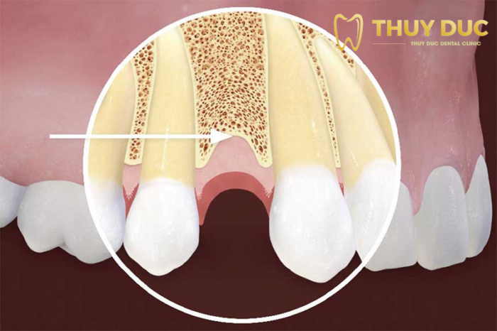 Nâng xoang trong trồng răng implant là gì? Khi nào cần nâng xoang khi trồng răng implant? 1