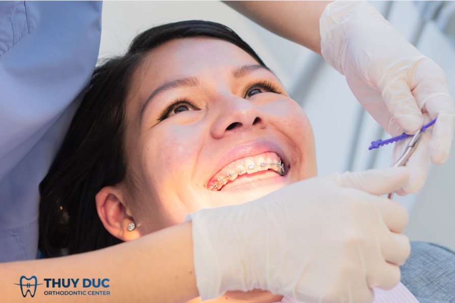 Các phương án niềng răng hô không nhổ răng 1
