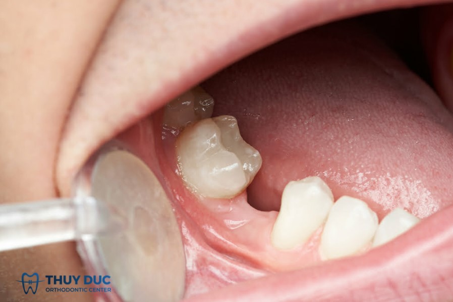 Nhổ răng khi niềng răng hô có nguy hiểm không? 1