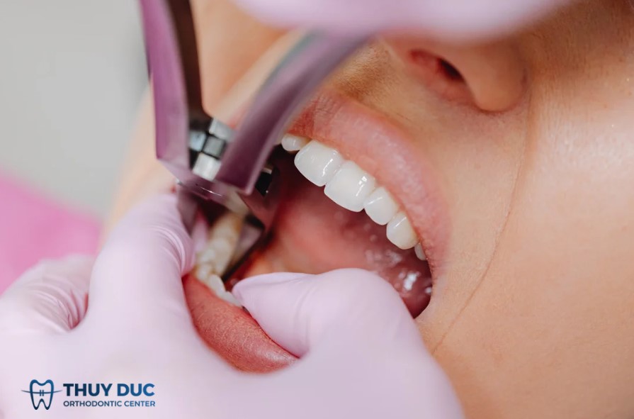 Các yếu tố cân nhắc khi quyết định nhổ răng hô 1