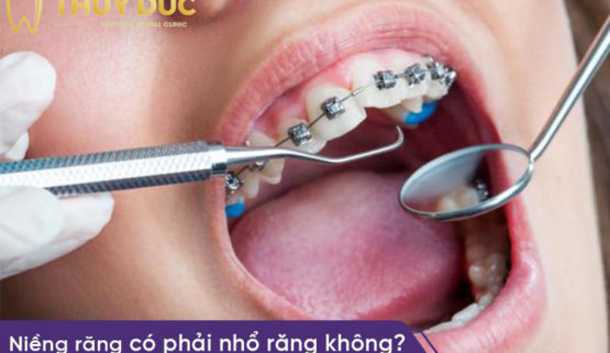 Niềng răng có phải nhổ răng không? Phải nhổ bao nhiêu răng?