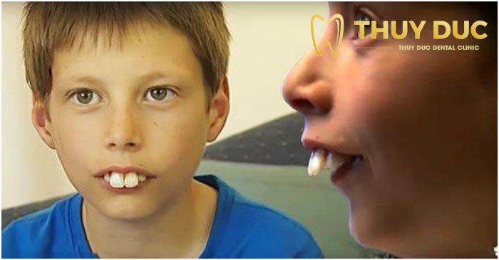 Cách bảo vệ toàn diện răng cho trẻ nhỏ cha mẹ cần nắm rõ  nhakhoathuyanh