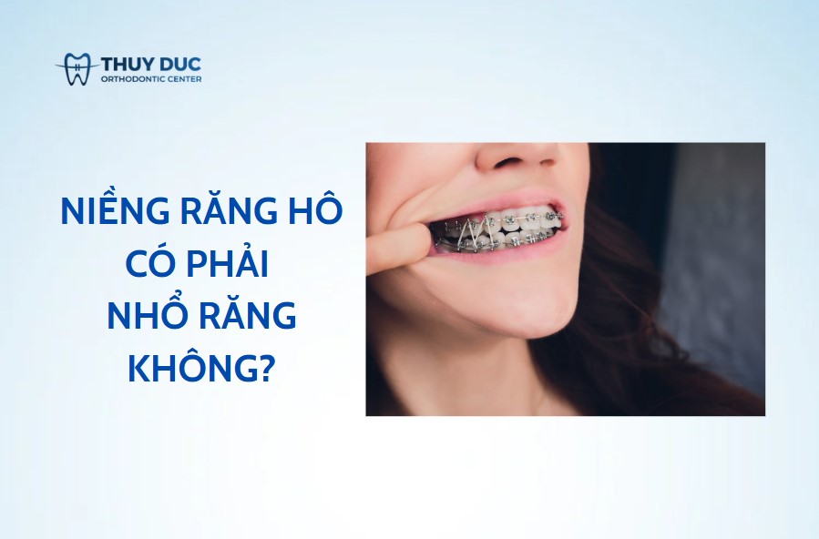 Khi nào niềng răng hô phải nhổ răng? 1