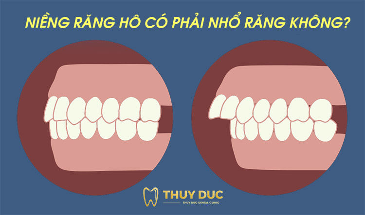 Niềng răng trong suốt Invisalign: 1
