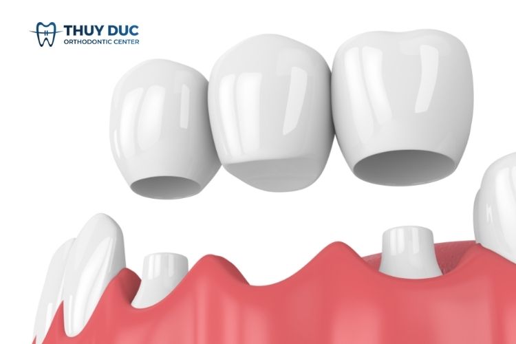 Cầu răng sứ là gì? 1