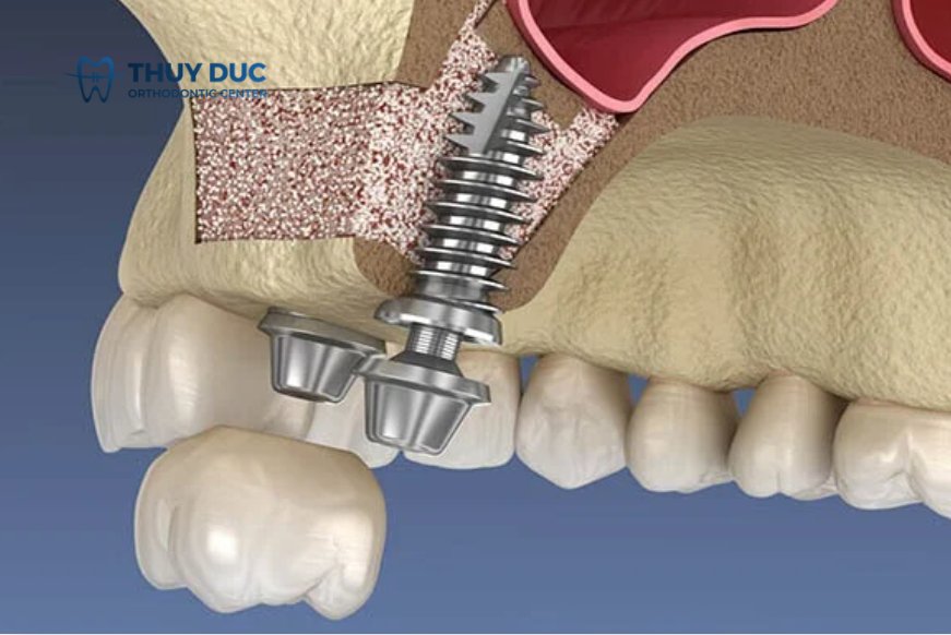 Nâng xoang trong trồng răng implant là gì? Khi nào cần nâng xoang khi trồng răng implant? 1