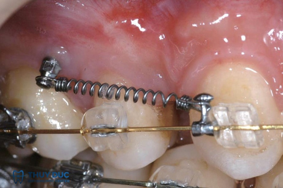 Quy trình cắm vít khi niềng răng 1