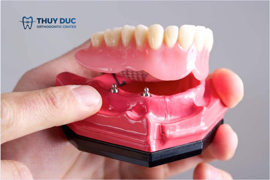 Răng giả tháo lắp trên trụ implant 1