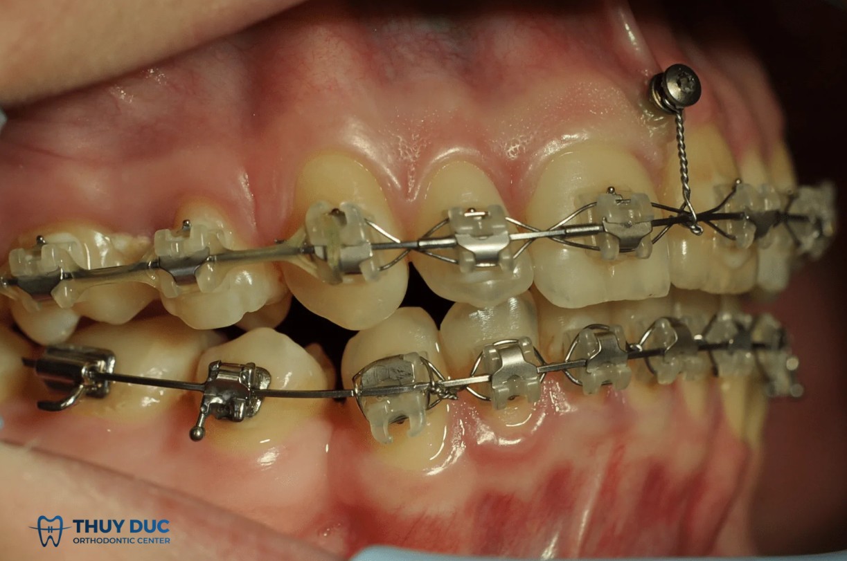 Vít niềng răng thường được cắm ở đâu? 1