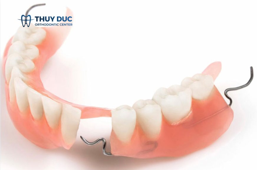 Hàm giả tháo lắp bằng khung kim loại 1