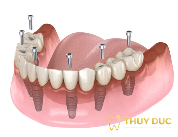 Trồng răng implant All on 4, All on 6 1