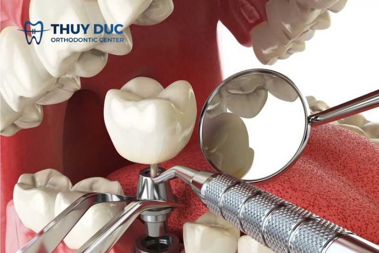 implant tức thì là gì? 1