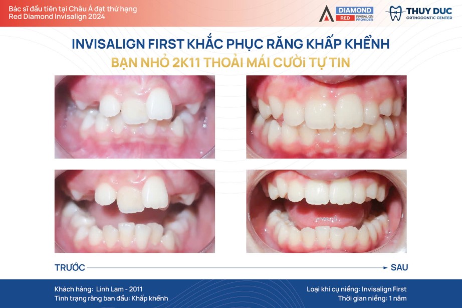 Quy trình niềng răng trong suốt Invisalign tại nha khoa Thúy Đức 3