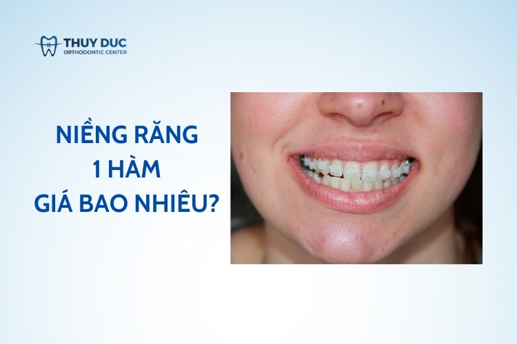 Niềng răng 1 hàm hết bao nhiêu tiền? 1