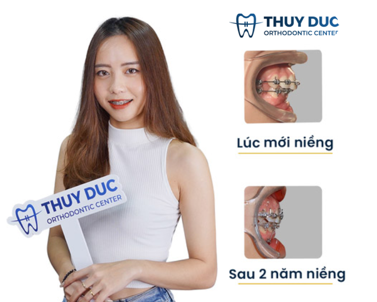 Đánh giá của khách hàng niềng răng tại Nha khoa Thúy Đức 4