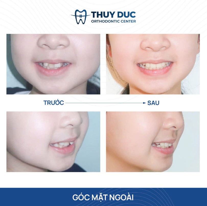Phương pháp niềng răng mắc cài bằng kim loại 2