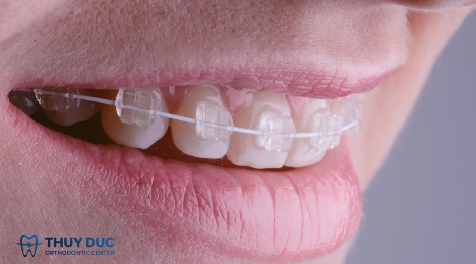 1. Niềng răng mắc cài sứ là gì? 1