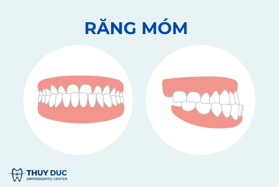1. Cách nhận biết sớm tình trạng móm sau khi niềng răng 1