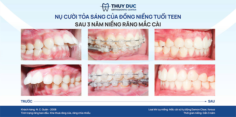 Các trường hợp nên chỉnh nha 1