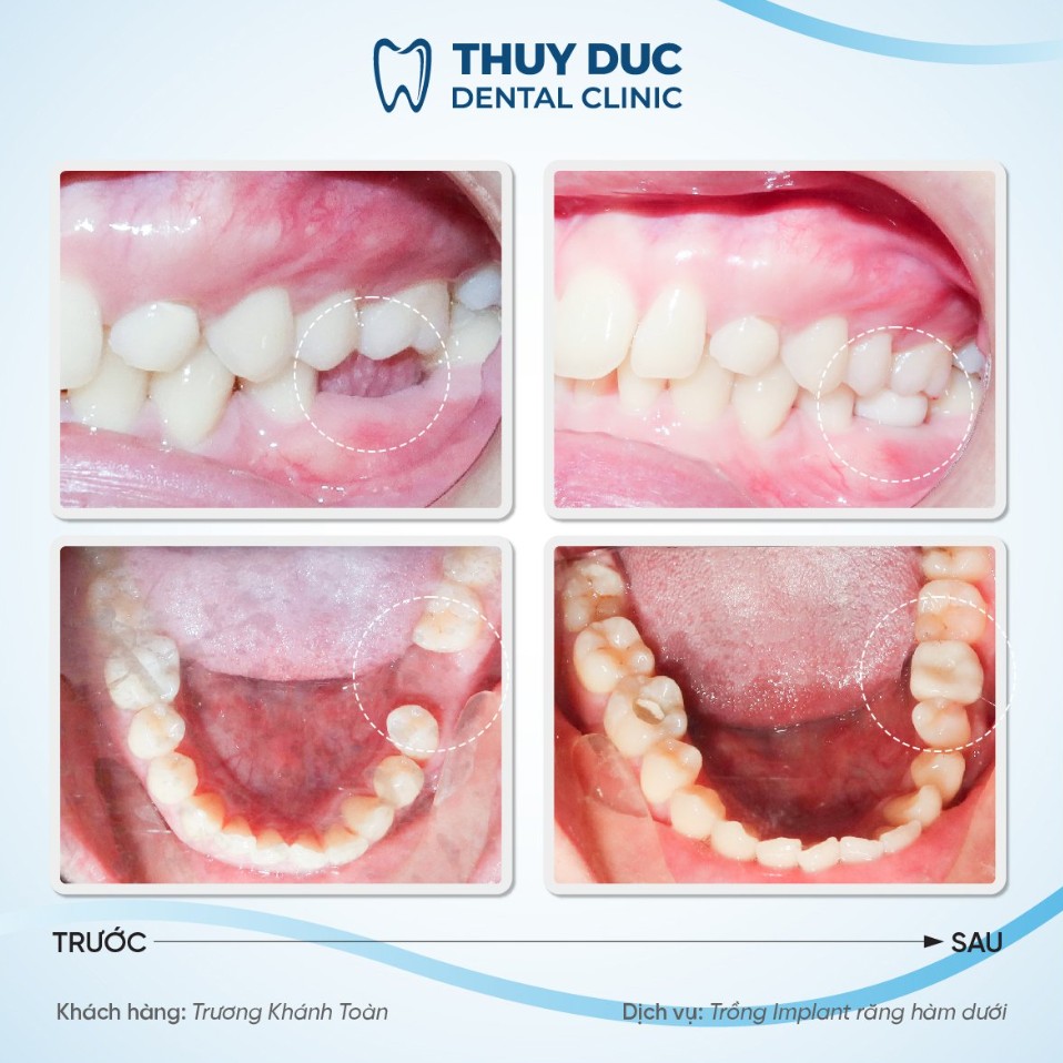 Địa chỉ trồng răng implant uy tín, chất lượng tại Hà Nội 2