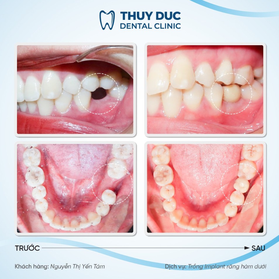 Địa chỉ trồng răng implant uy tín, chất lượng tại Hà Nội 3