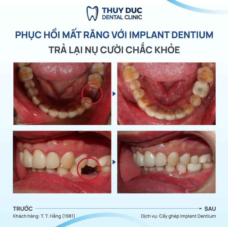 2. Trụ implant Dentium - Hàn Quốc 2