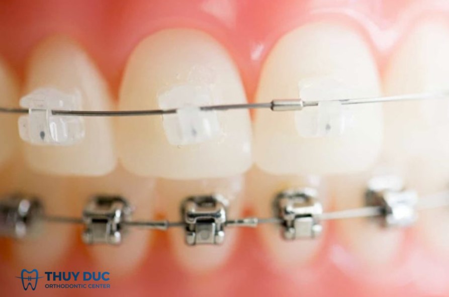 Niềng răng mắc cài sứ tự động 1