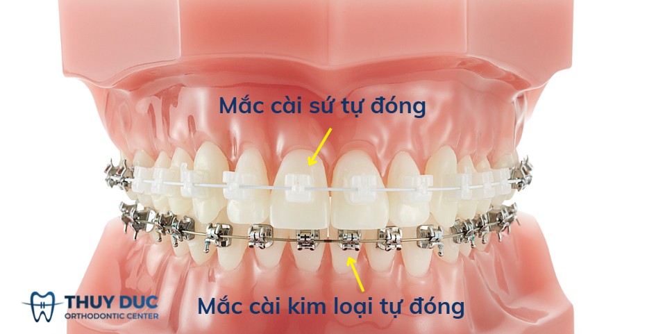 3.2. Mắc cài sứ tự buộc (self-ligating) 1
