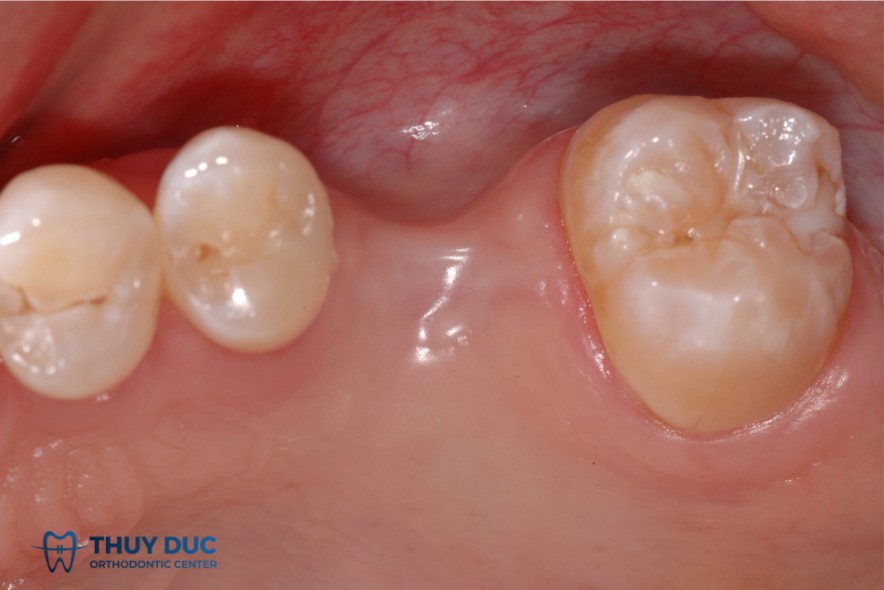 1. Hậu quả khôn lường khi mất răng số 6 1