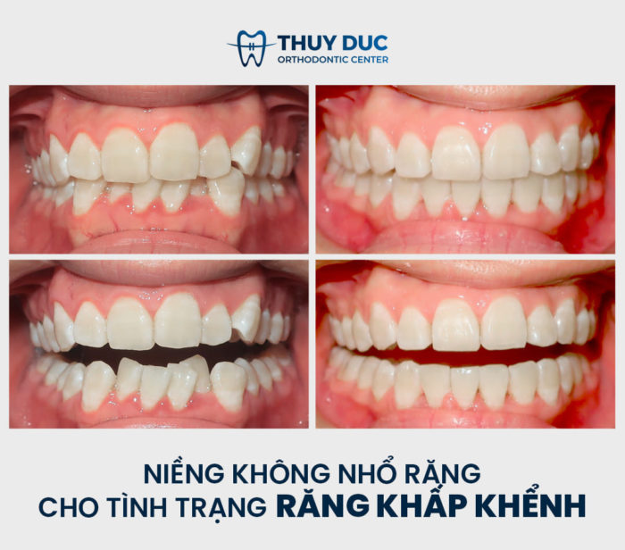 Niềng răng trong suốt Invisalign 1