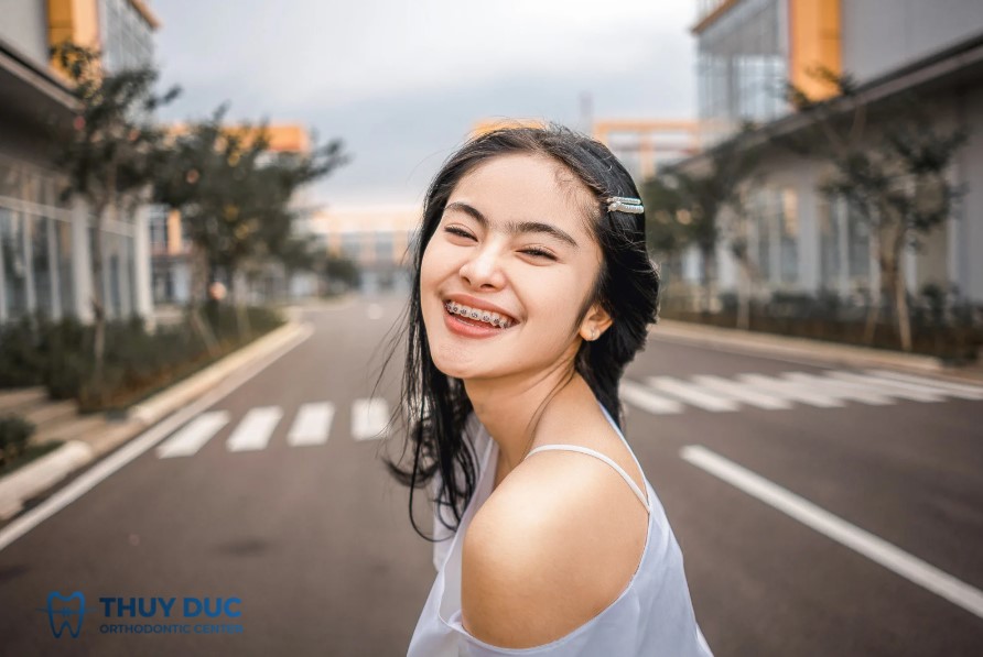 2.1. Niềng răng mắc cài kim loại – Cồng kềnh và dễ va chạm nhất 1
