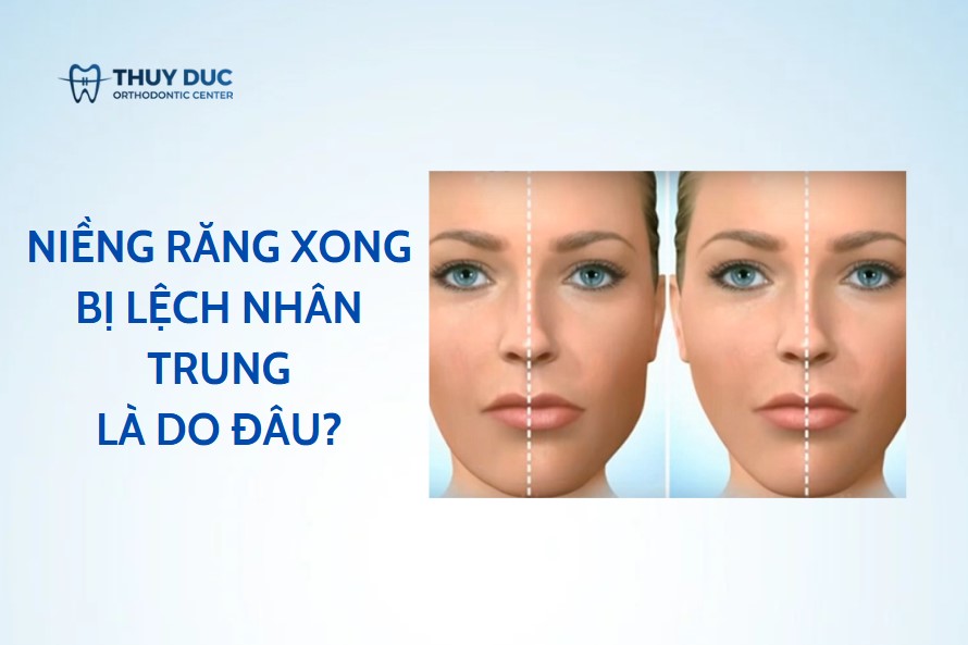 Niềng răng xong bị lệch nhân trung là do đâu? Khắc phục như thế nào? 1