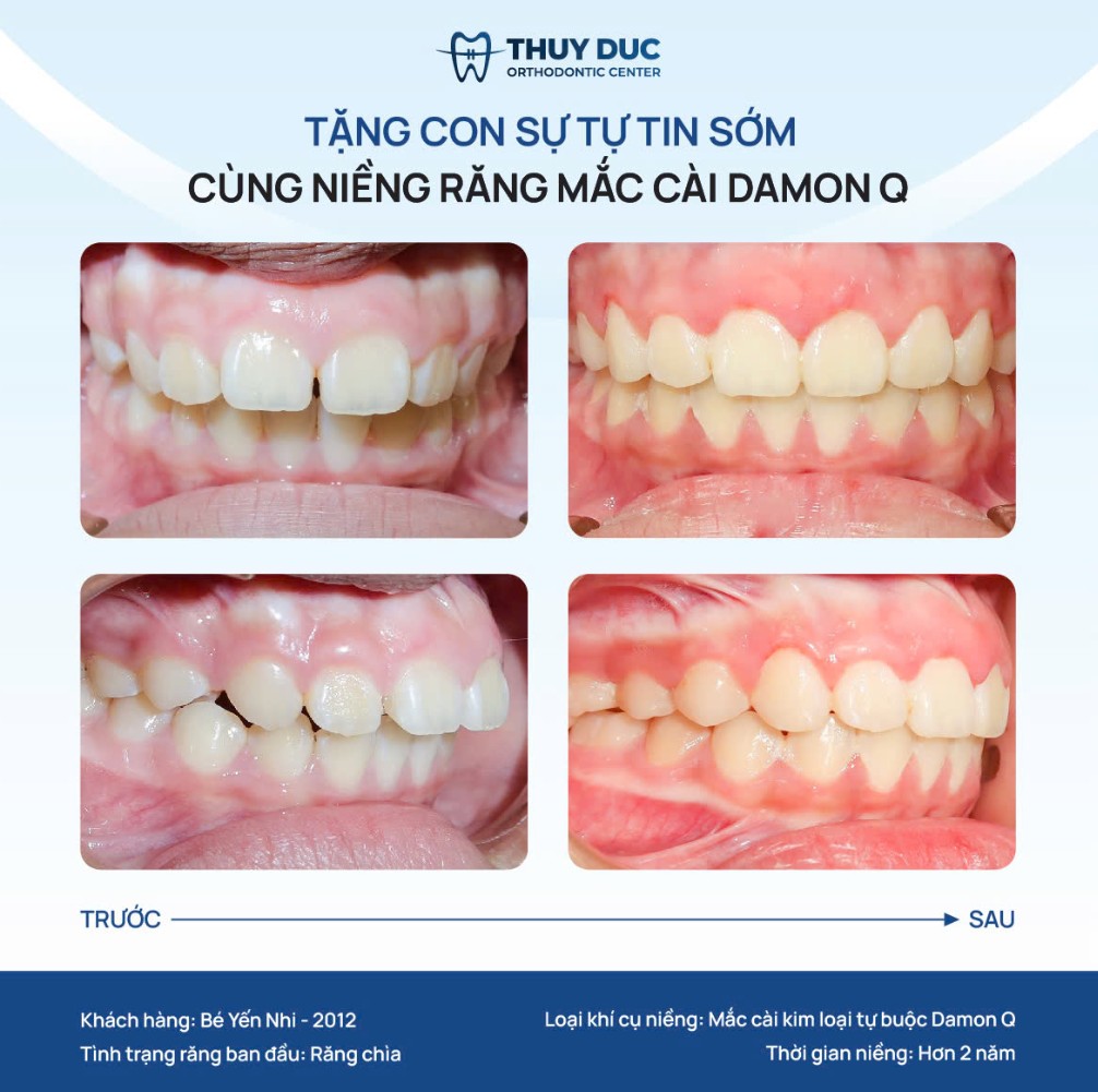 Niềng răng cho trẻ em có đắt không? 1
