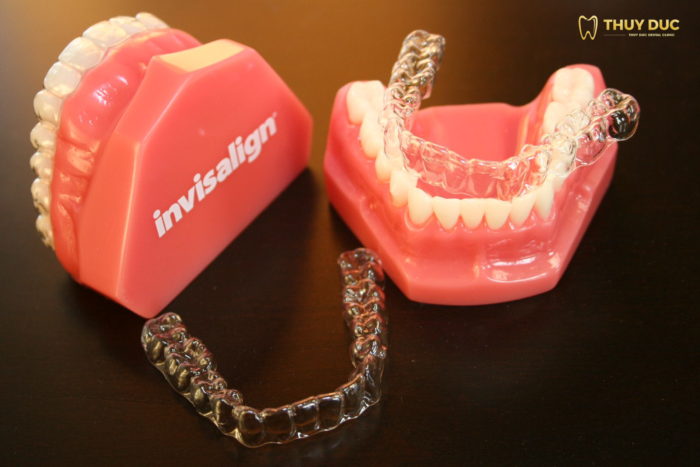 Niềng răng trong suốt Invisalign 1