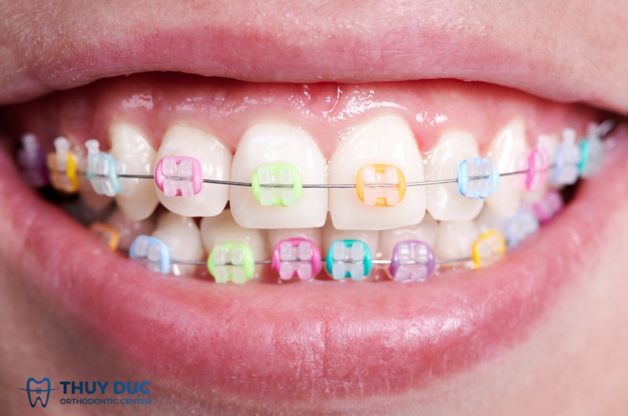 Niềng răng mắc cài sứ thường 1