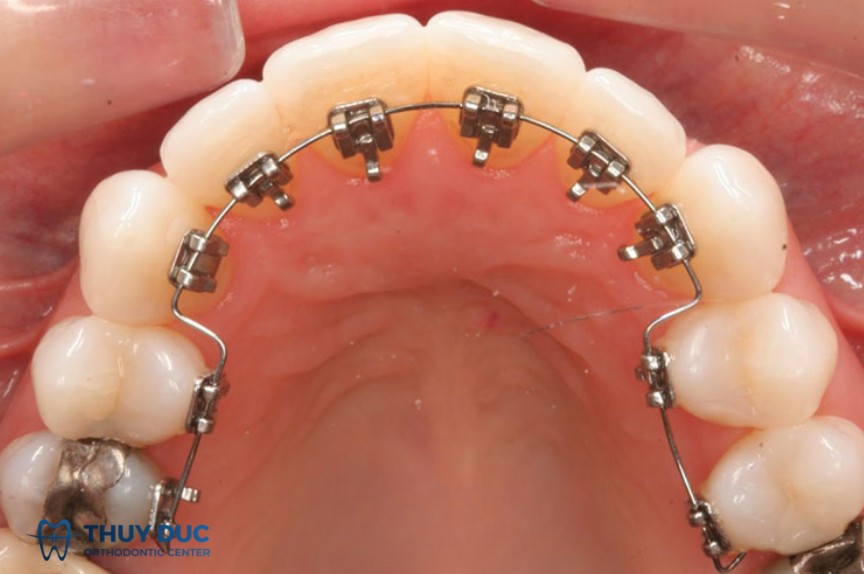 Niềng răng mắc cài mặt trong 1