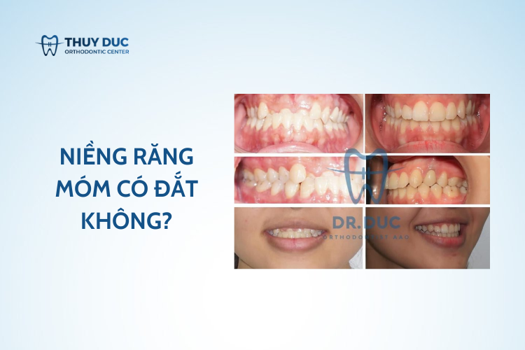 Niềng răng móm có đắt không? Hết bao nhiêu tiền?