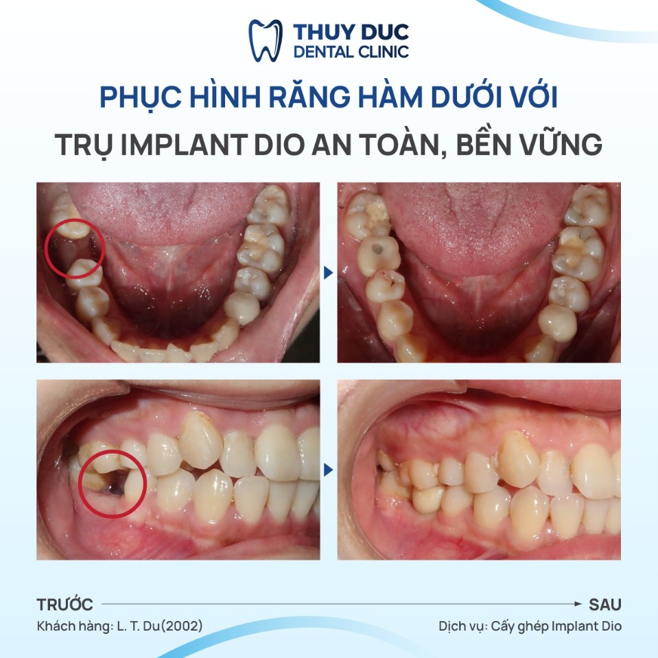 3/ Trụ implant DIO 2