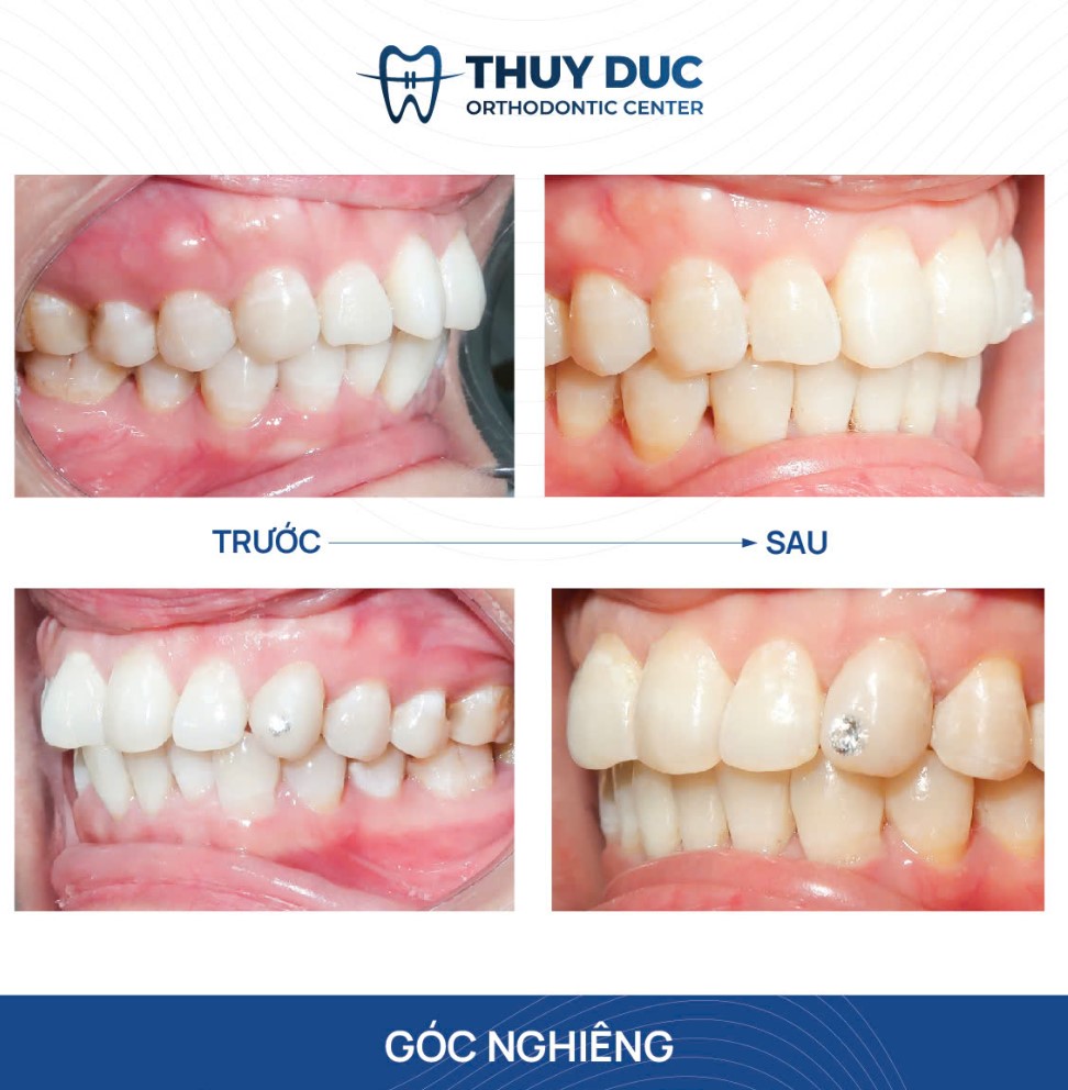 Răng hô nhẹ có nên niềng không? 1