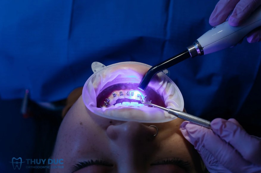 1.3. Sai lầm trong quá trình chỉnh nha 1