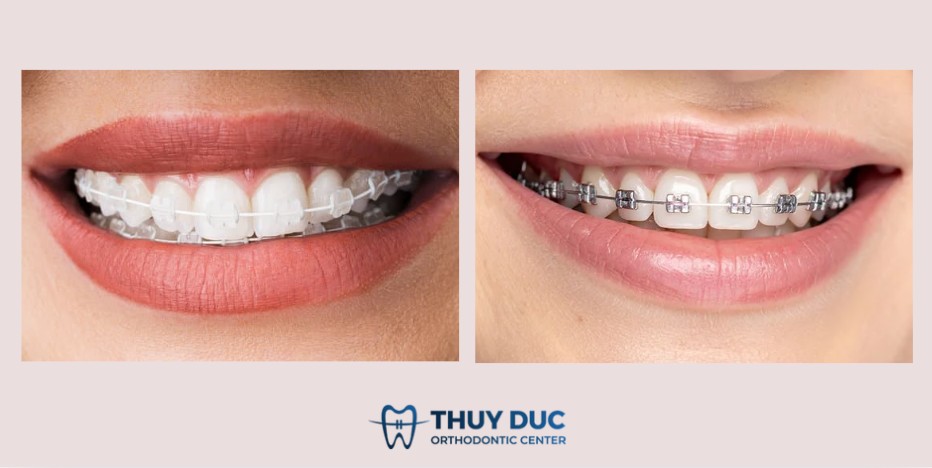 Gợi ý thực tế từ bác sĩ chỉnh nha 1