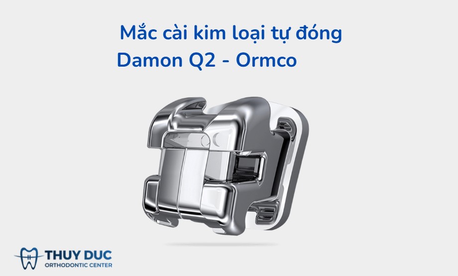 2. Damon Q2 - Mắc cài tự đóng kim loại thế hệ mới 1
