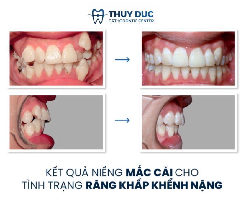 1. Thế nào là răng khấp khểnh? 1