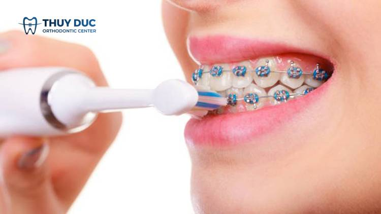 Tại sao niềng răng xong bị khớp cắn sâu? 2