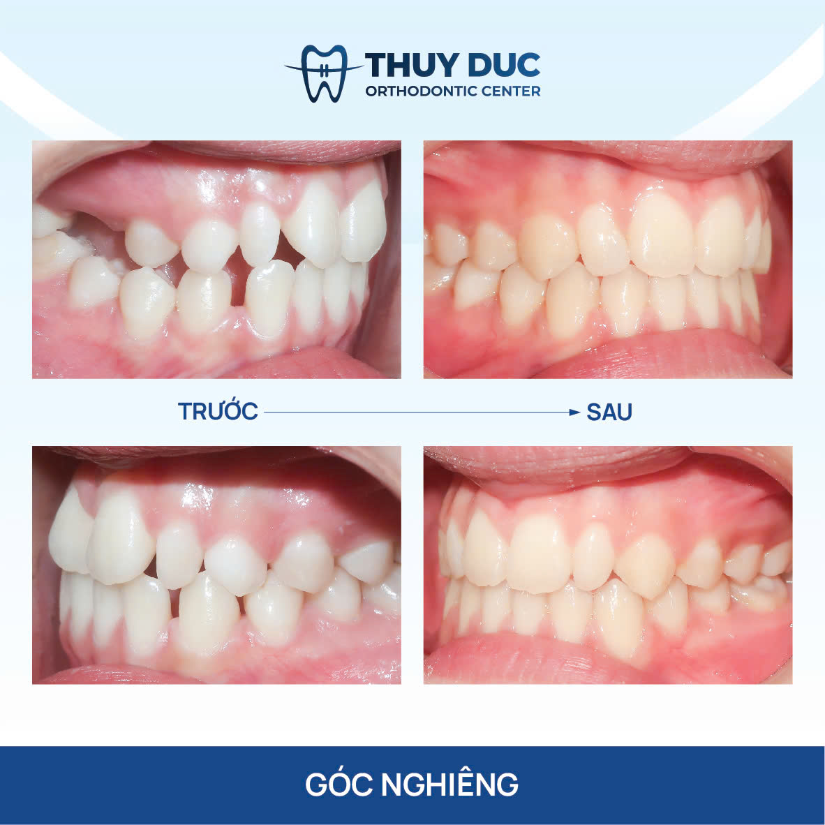 Răng thưa, hở kẽ 1