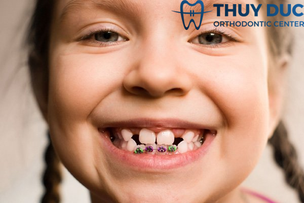 Niềng răng không cần nhổ răng cho trẻ - Công nghệ mới, hiệu quả cao 1