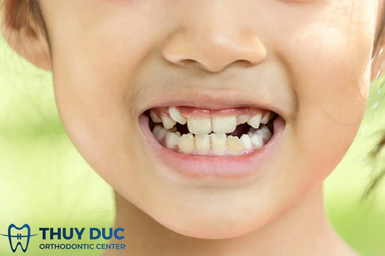 Niềng răng không cần nhổ răng cho trẻ với phương pháp niềng răng Invisalign 1