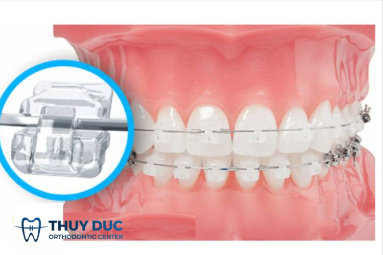 Phương pháp niềng răng thưa bằng mắc cài 3