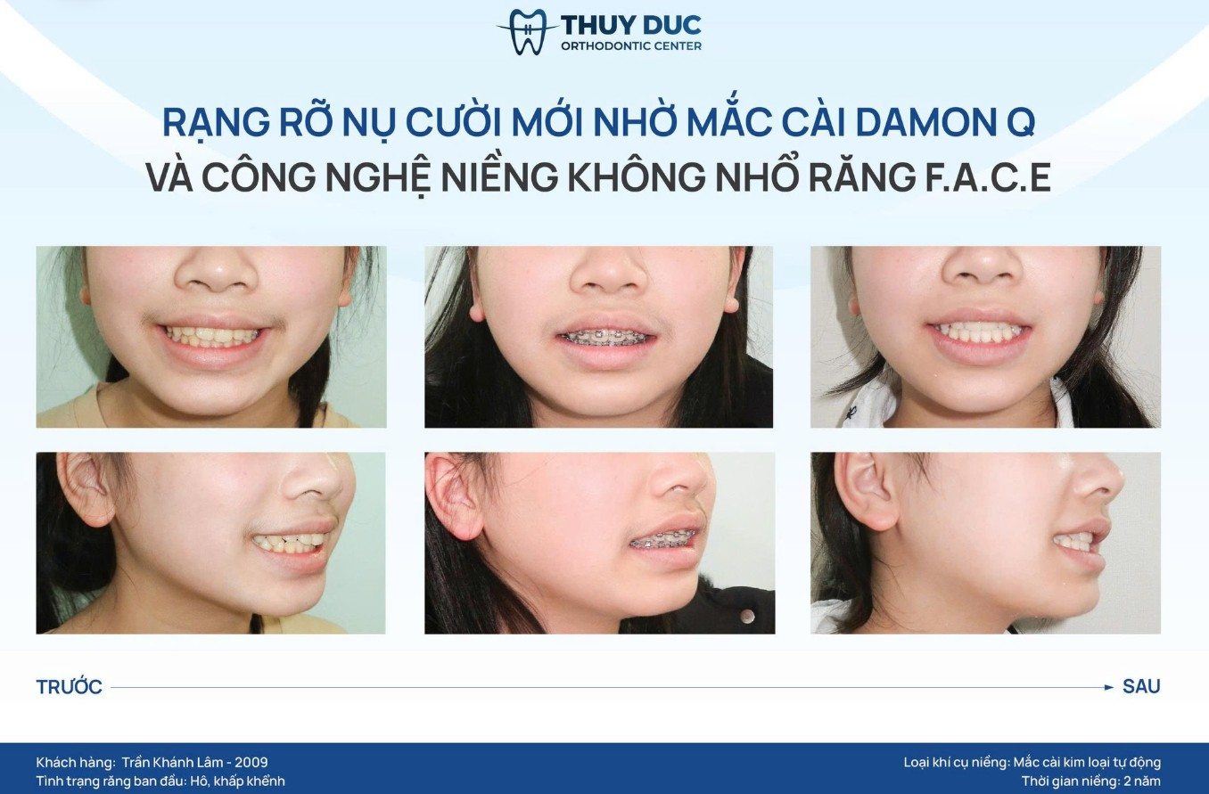 Niềng không nhổ răng F.A.C.E là gì? 1